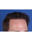After Hair Transplant&nbsp;Front